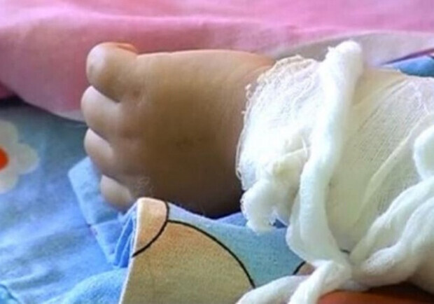 В запорожскую больницу попала малышка с сильными ожогами. Фото: bbc